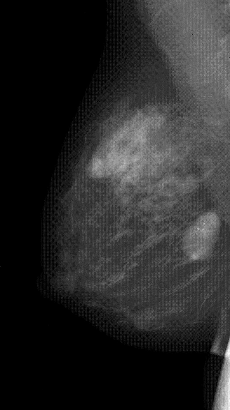 Mammograph FFDM